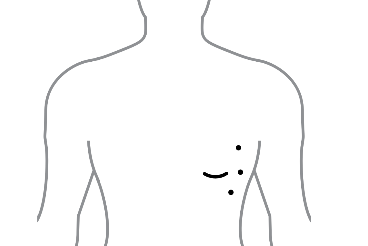 Diagram showing the locations of incisions for robot assisted MIDCAB