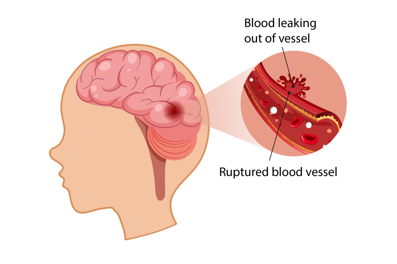 graphic illustration of the brain and blood leaking out of a vessel