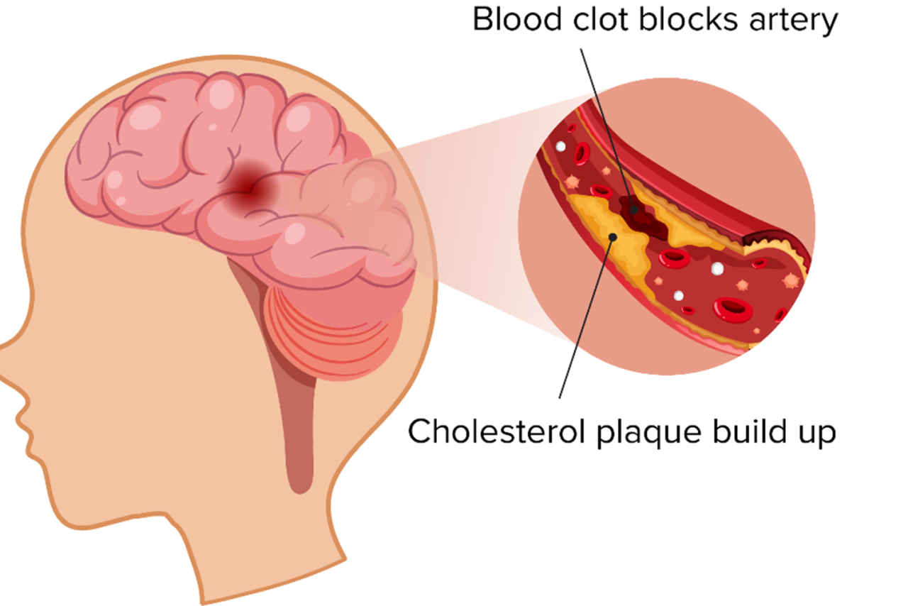 graphic illustration of the brain and a clot in a blood vessel