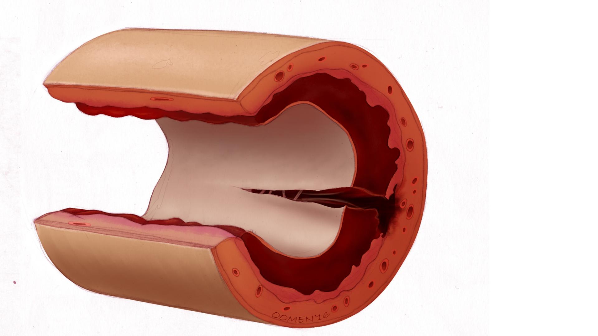 SCAD thrombus 