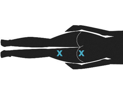 illustration showing possible locations on the back of the leg for lower sciatic nerve blocks